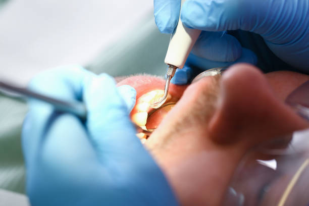 Best Emergency Treatment for Dental Infections or Abscesses in Factoryville, PA